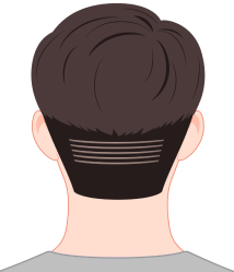 한나이브비절개채취,미세라인컷