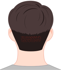 한나이브비절개채취,노컷