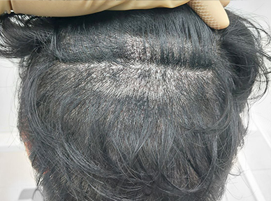술후