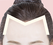 한나이브모발이식,M자이마