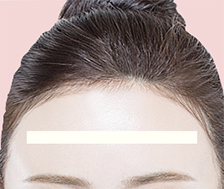 한나이브모발이식,넓은이마