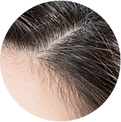 한나이브모발이식,그라데이션이식