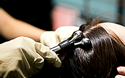 한나이브이식후관리,두피초음파