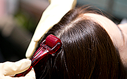 한나이브이식후관리,MTS메조테라피