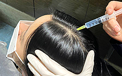 한나이브이식후관리,두피영양엠플관리