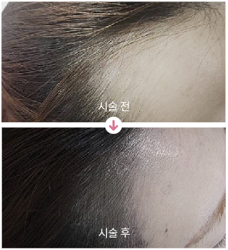두피문신전후사진,헤어라인커버