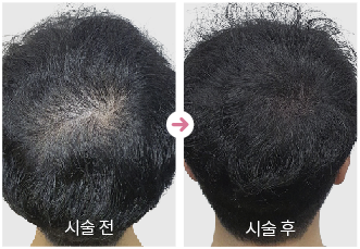 두피문신전후사진,남성정수리커버