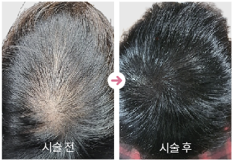 두피문신전후사진,남성정수리커버