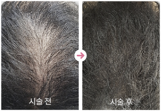 두피문신전후사진,남성정수리커버