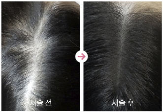 두피문신전후사진,여성가르마커버